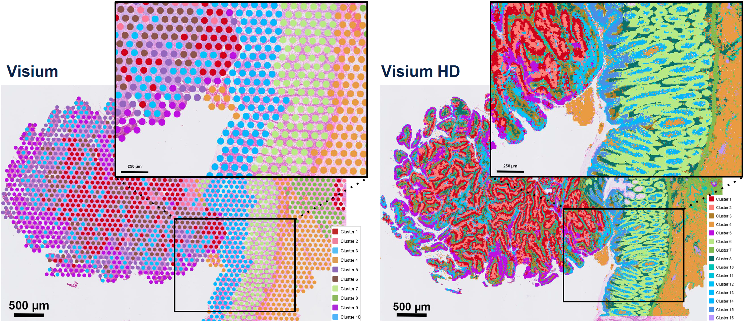 side-by-side images of human colorectal cancer analyzed with Visium and Visium HD assays