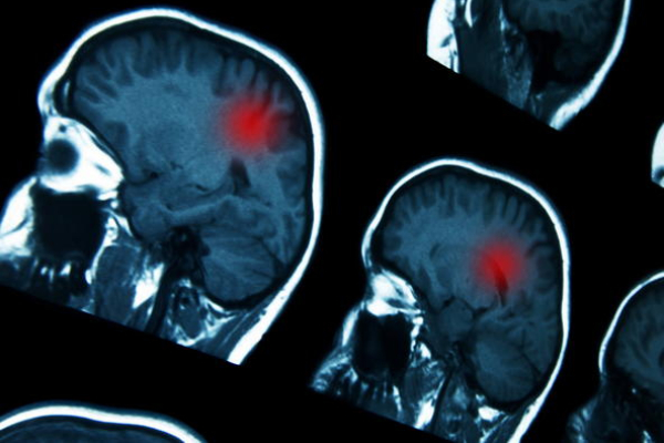 Markey researchers identify genetic marker that could guide brain cancer treatment
