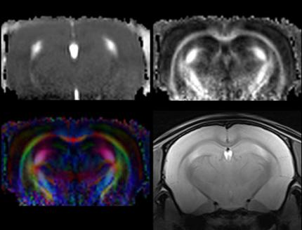 Diffusion tensor imaging