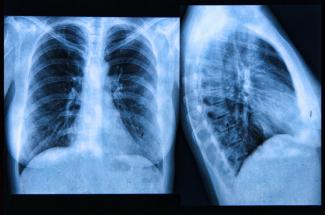 Image of chest x-ray