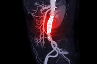 CTA of the abdominal aorta with stent-grafting in a patient.