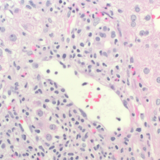 Liver biopsy slide